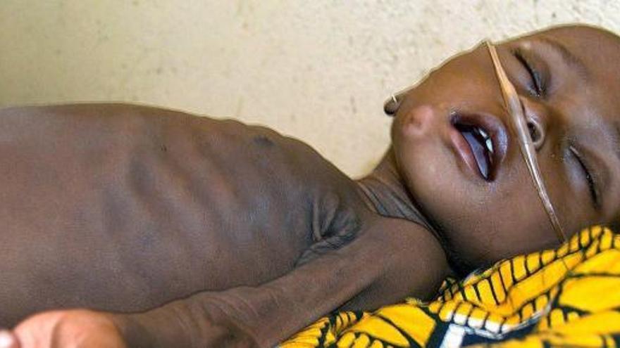 Un niño afectado de malnutrición.