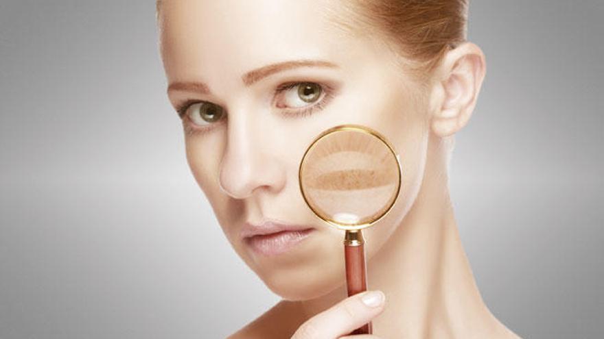 El acné en la edad adulta afecta a un 15% de las mujeres.