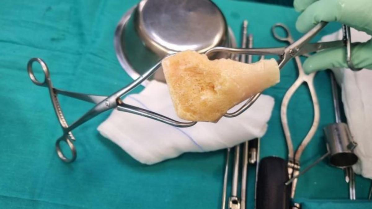El Molina Orosa realiza por primera vez una cirugía con injerto de hueso