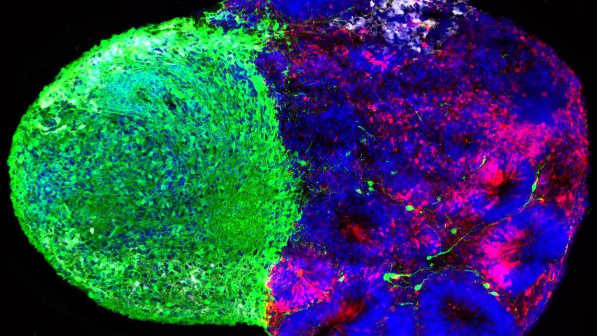 Los organoides derivados de células madre talámicas (verdes) y corticales (rojas) se fusionan para estudiar cómo las neuronas del tálamo influyen en las células progenitoras corticales inmaduras, llamadas glía radial (blanca), durante el desarrollo del cerebro.