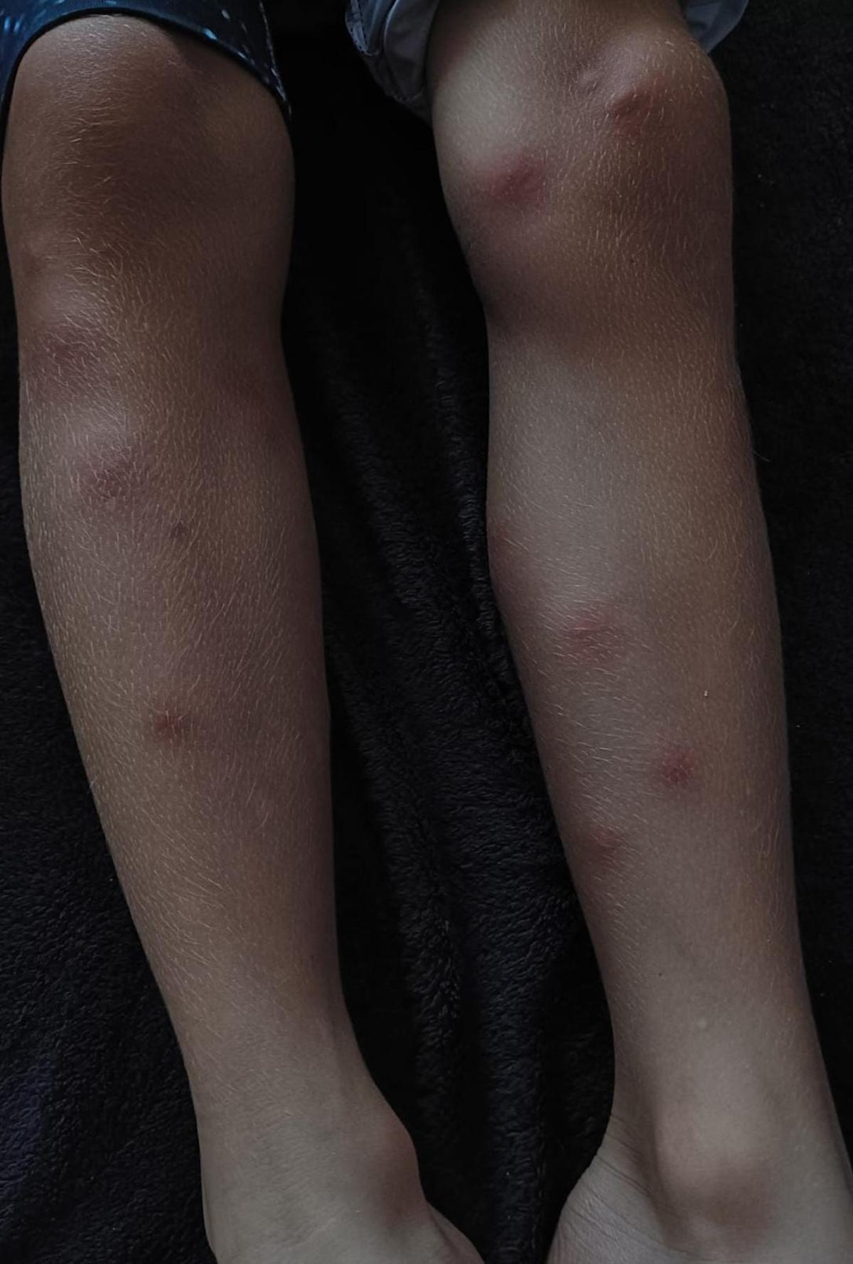 Picaduras sufrida por un niño.