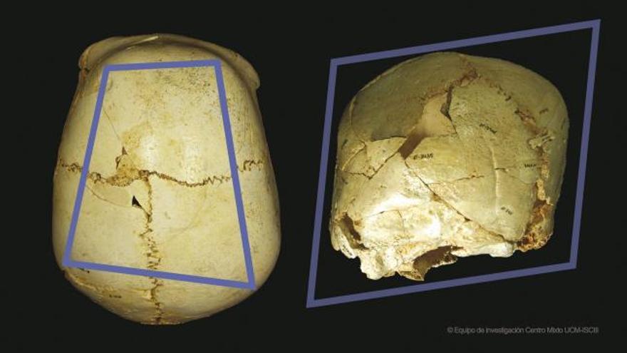 Un grupo de paleontólogos del equipo de Atapuerca ha identificado un cráneo del yacimiento de la Sima de los Huesos con una rara patología craneal derivada de la fusión prematura de las suturas de esta caja ósea.