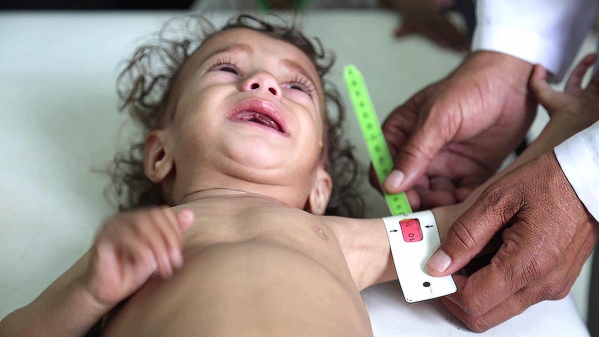 Yemen desnutrición