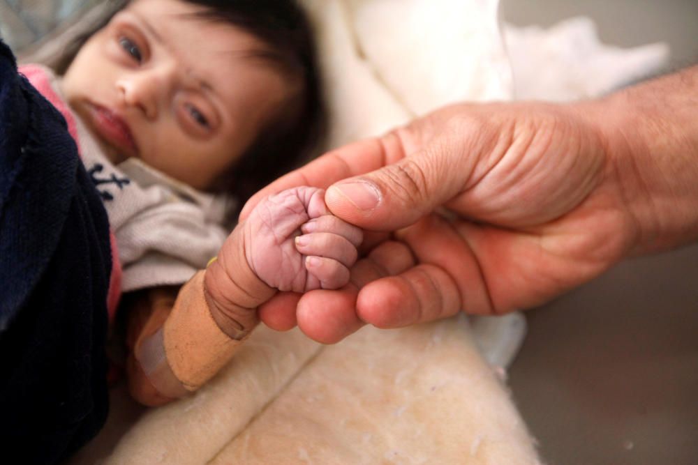 Nurse holds a hand of malnourished two-month-old ...