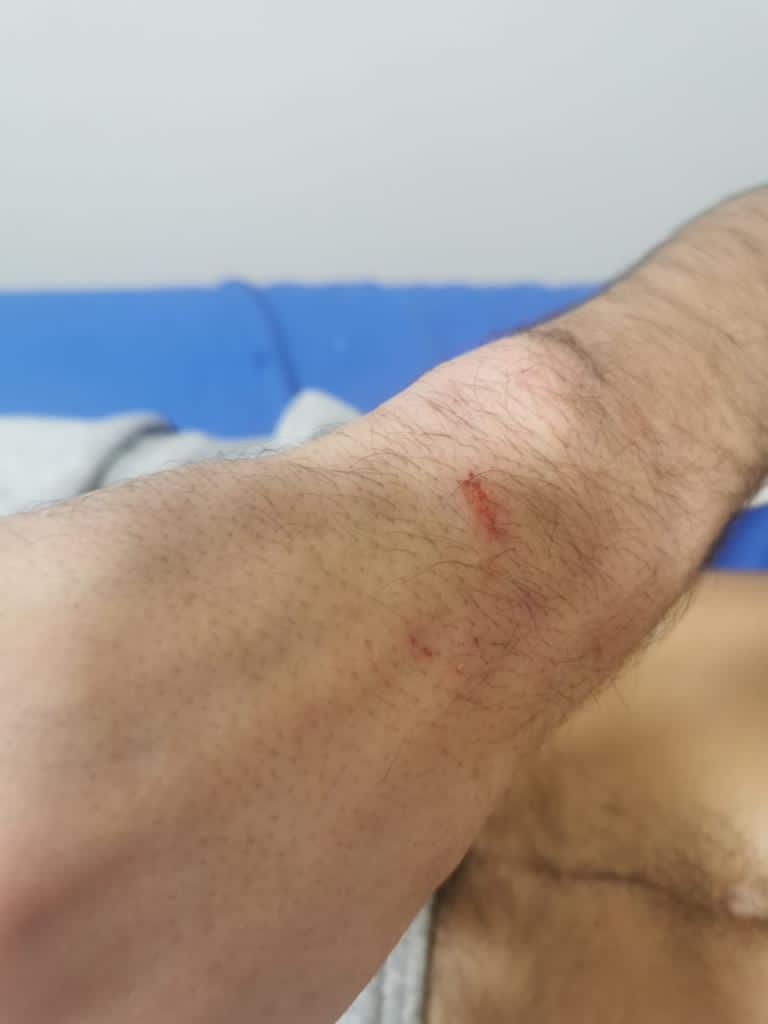 Kevin muestra sus heridas tras la trifulca