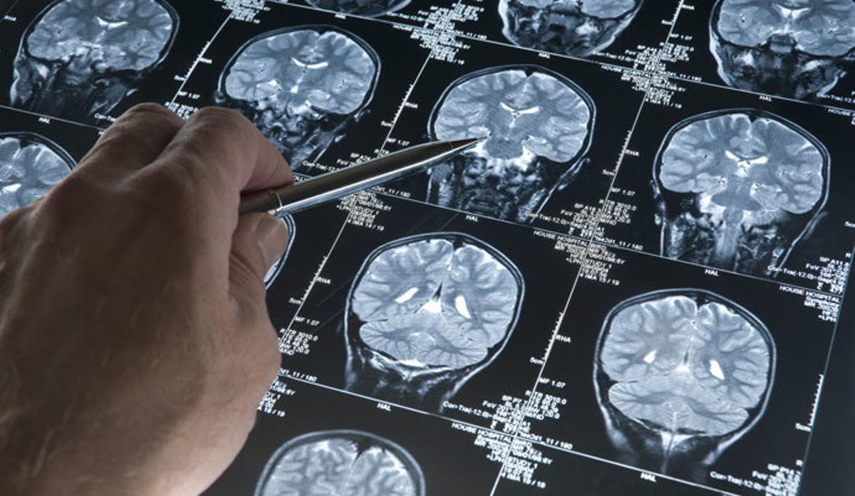 ¿Cuál es la diferencia entre el alzhéimer y la demencia?