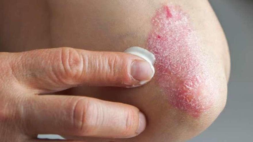 Una persona con psoriasis, echándose crema. // FdV