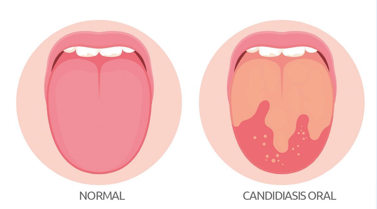 Oral candidiasis