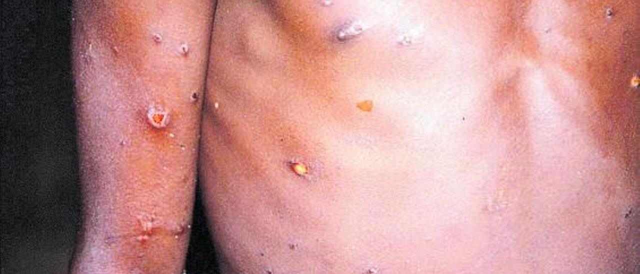 Torso y parte del brazo de un afectado por la viruela del mono en el Congo. |   // BRIAN W. J. MAHY