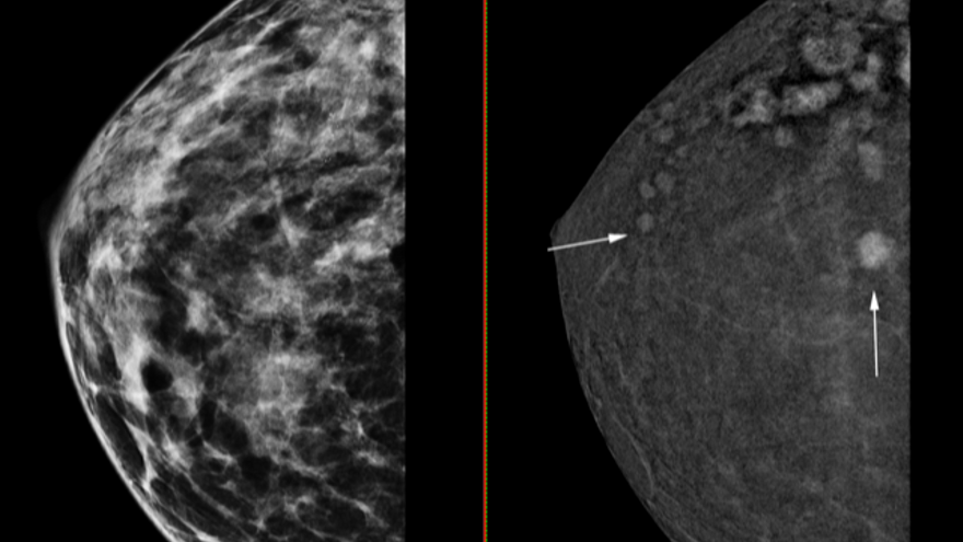 Los pequeños tumores que es capaz de detectar el mamógrafo.