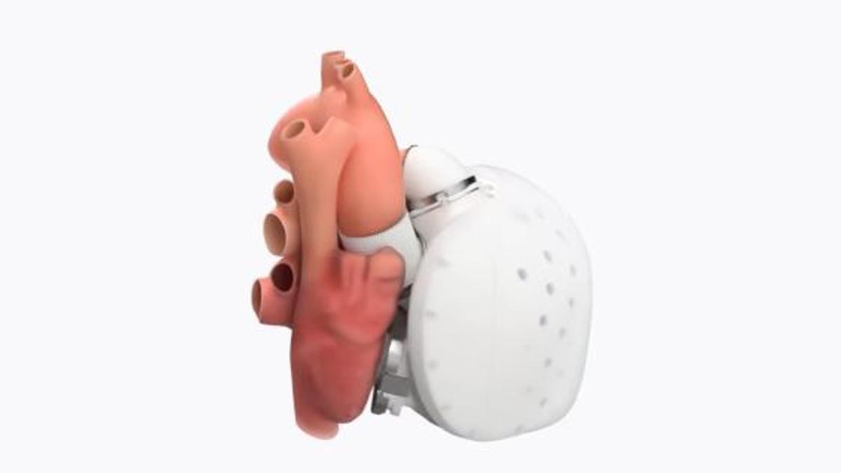 Así es el corazón artificial de Carmat que podría salvar vidas