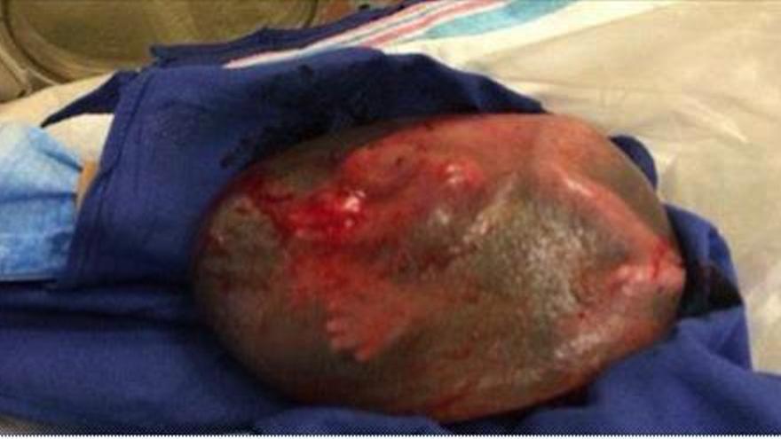 Impactant naixement d&#039;un nadó dins del sac amniòtic