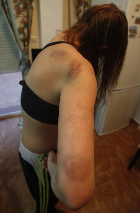 La mujer violada por su jefe en València muestra las heridas sufridas en el ataque.