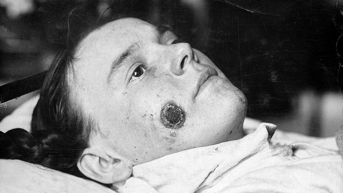 Mujer con una herida de ántrax en el rostro