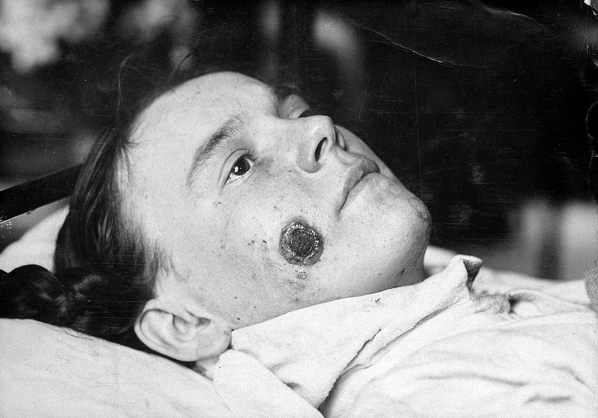 Mujer con una herida de ántrax en el rostro