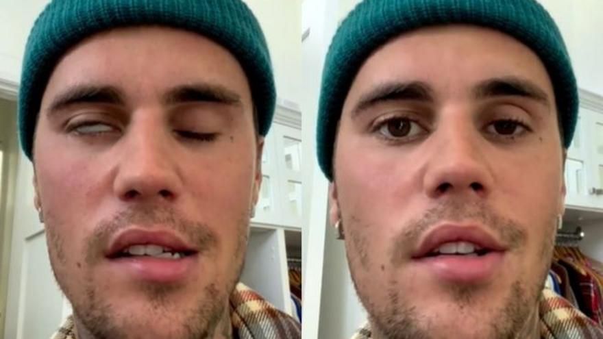 Justin Bieber mostrant els efectes que li provoca la síndrome de Ramsay-Hunt