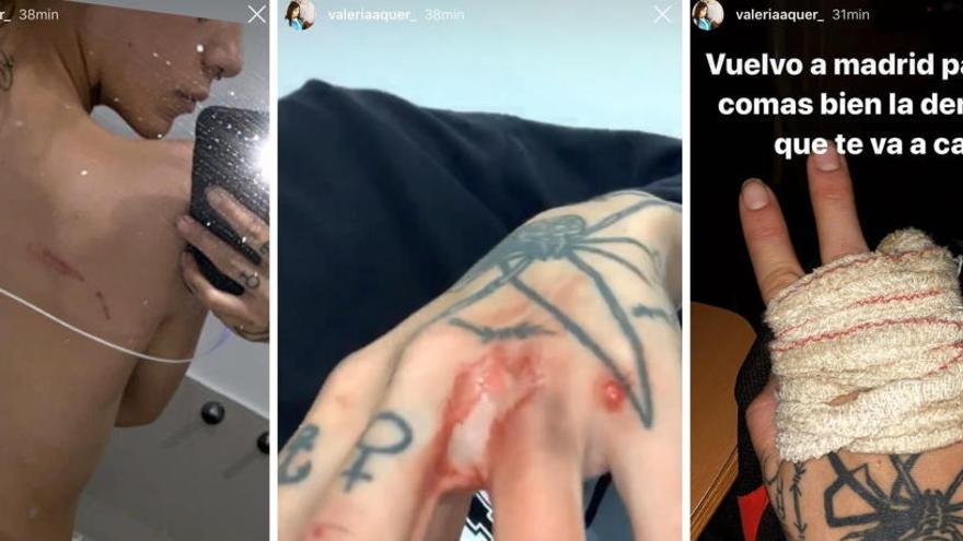 Valeria Quer denuncia en Instagram una agresión de su pareja con fotos de las heridas