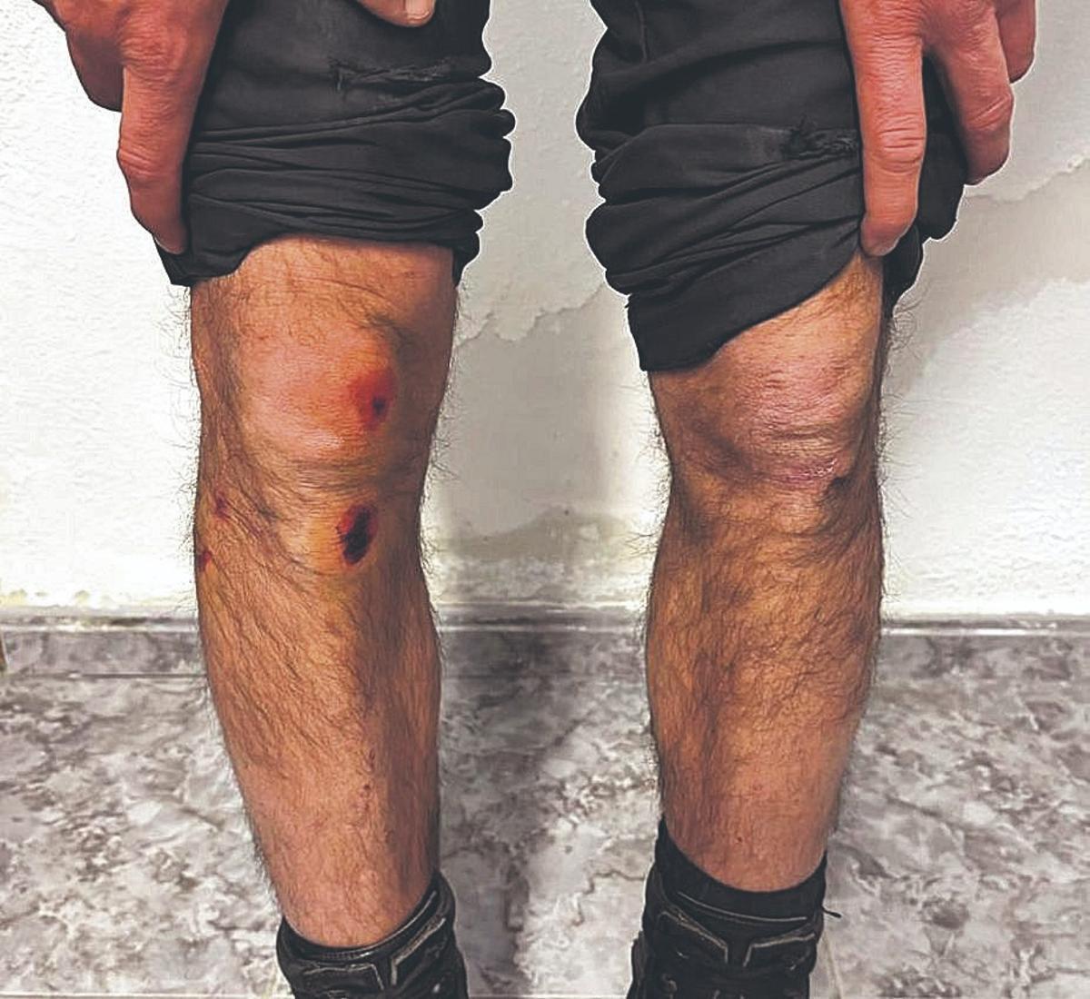 Heridas y quemaduras en las piernas del guardia civil arrollado.