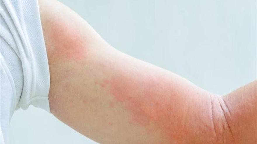 Urticaria colinérgica, alergia al agua.