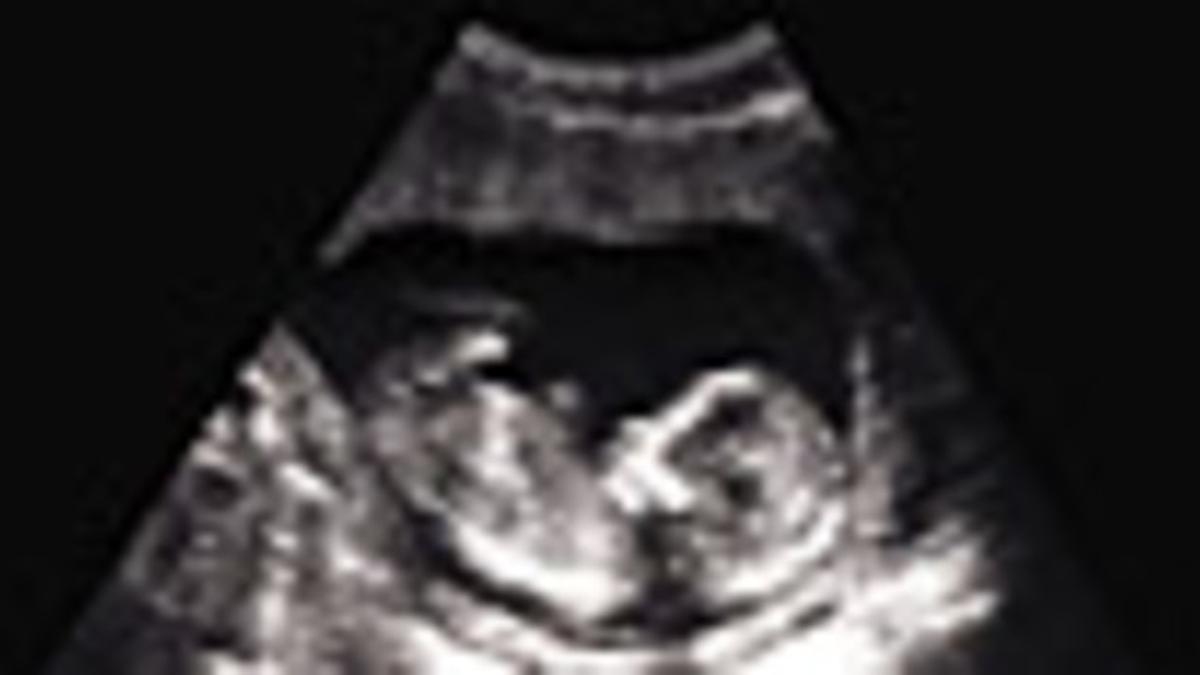 Ecografía de un feto de 14 semanas de gestación generado en el Instituto Cefer de Barcelona tras la donación a la mujer gestante de un óvulo de su pareja.