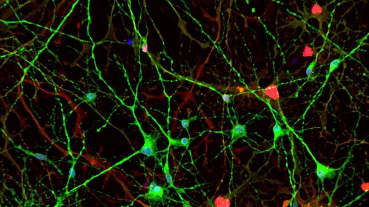 Un estudio del Instituto de Neurociencias identifica el aumento de una proteína en el cerebro y de líquido cefalorraquídeo en personas con alzhéimer