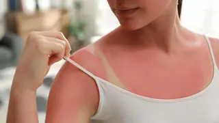 "Callo solar", la peligrosa práctica que los creadores de contenido están incentivando en TikTok