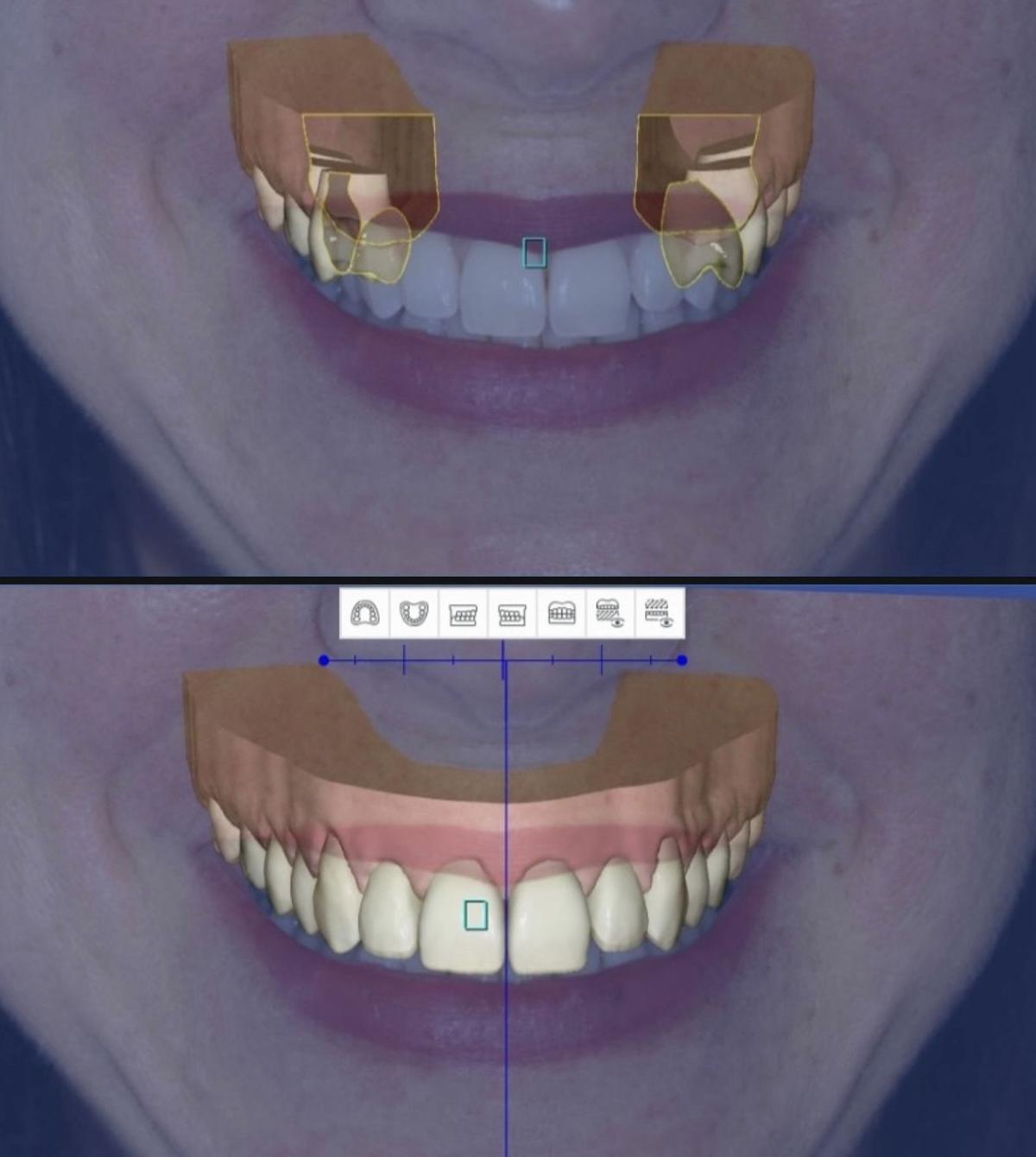 Implantología en Rambla Videl Dental.
