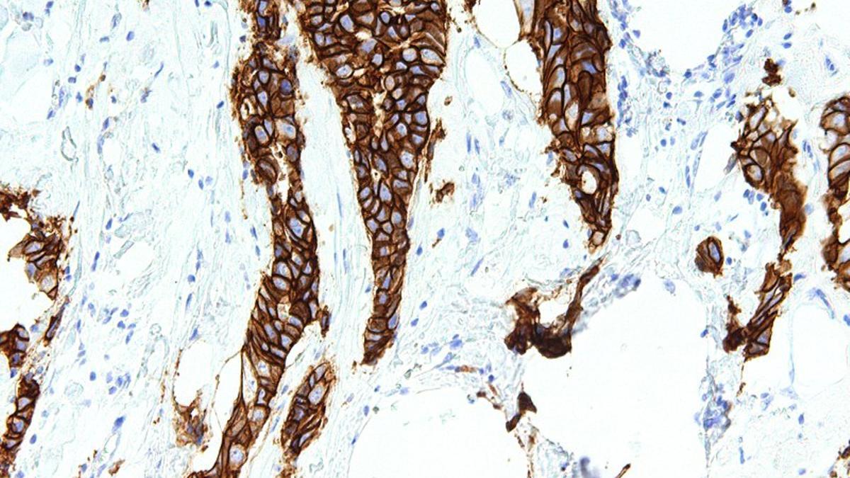 Proteína HER2 en tejido de cáncer de mama de una paciente / Wikipedia