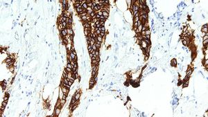Proteína HER2 en tejido de cáncer de mama de una paciente / Wikipedia