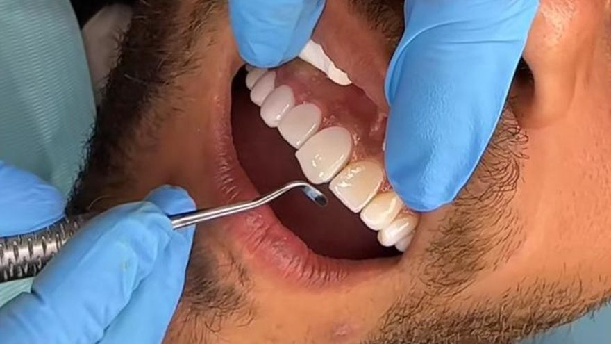 Alerta sobre la nova moda de viatjar al Marroc a la recerca del somriure perfecte: «És una temeritat»