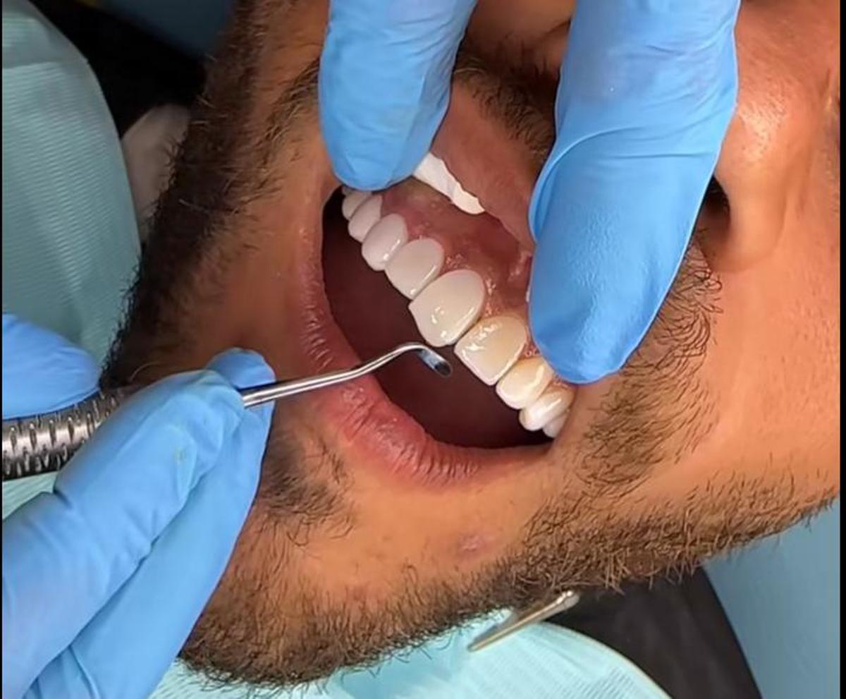 Alerta sobre la nova moda de viatjar al Marroc a la recerca del somriure perfecte: «És una temeritat» Alerta sobre la nova moda de viatjar al Marroc a la recerca del somriure perfecte: «És una temeritat»