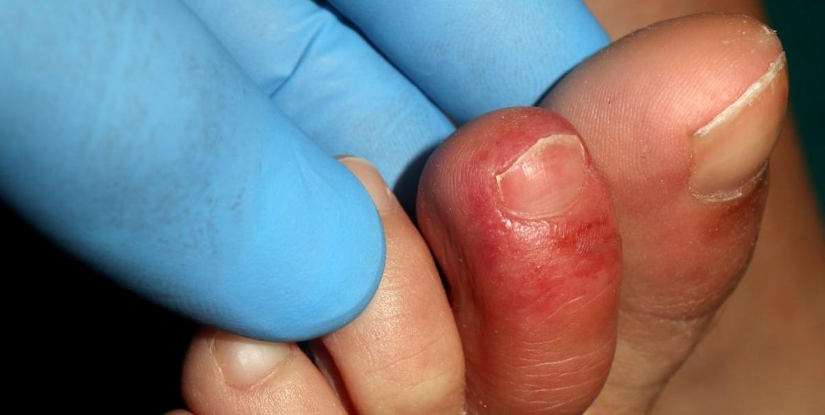 La dactilitis, o dedos en salchicha, es un síntoma de enfermedades reumatológicas