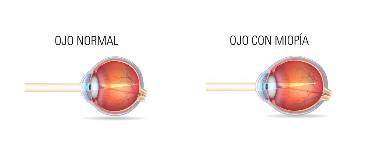 La miopía se produce cuando el globo ocular es demasiado alargado