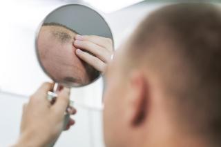 Olumiant: así es el primer fármaco aprobado contra la alopecia areata