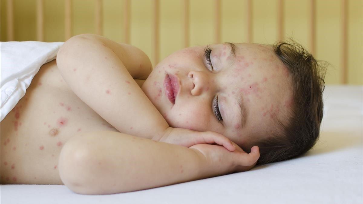 zentauroepp45578080 19225997 potrait of a sleeping child with red spots on his181024181305 zentauroepp45578080 19225997 potrait of a sleeping child with red spots on his181024181305