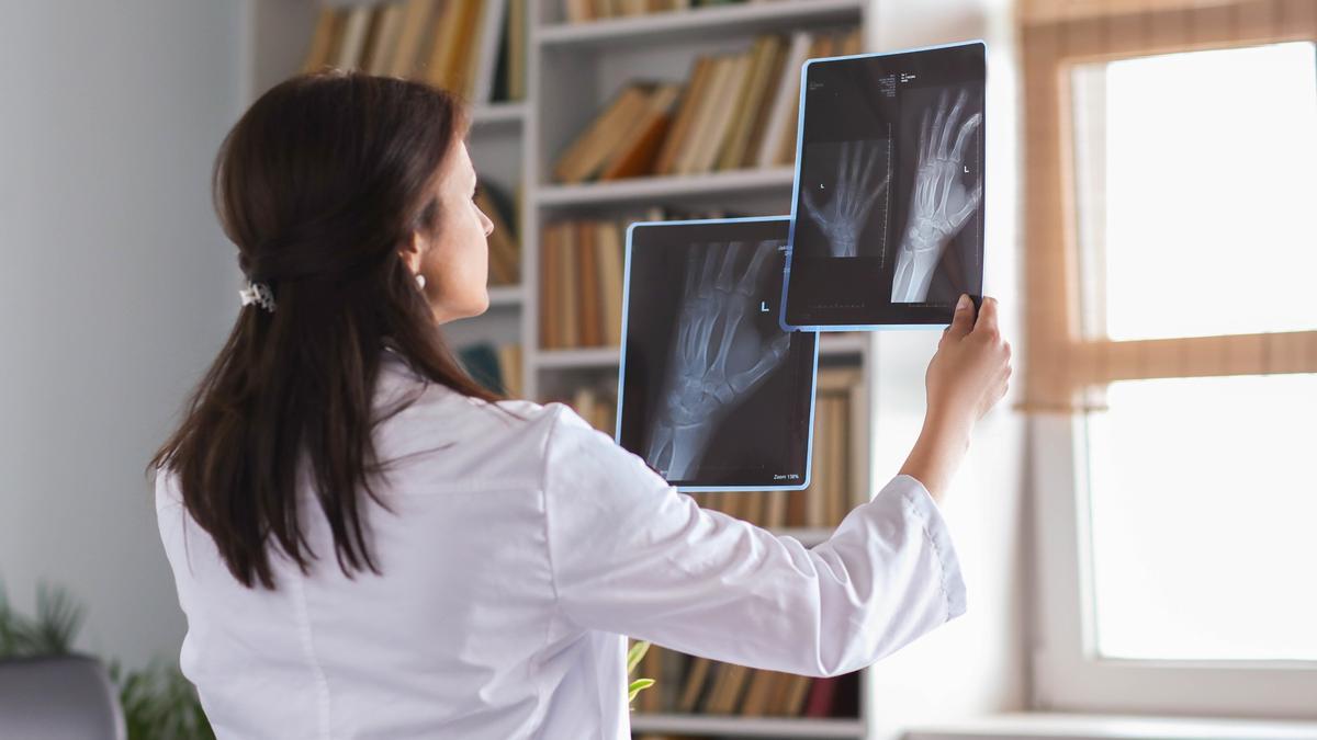 Osteoporosis: ¿Por qué las mujeres son más propensas a la rotura de vértebras, cadera o muñecas?