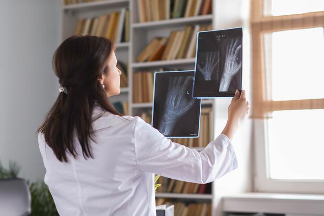 Osteoporosis: ¿Por qué las mujeres son más propensas a la rotura de vértebras, cadera o muñecas?