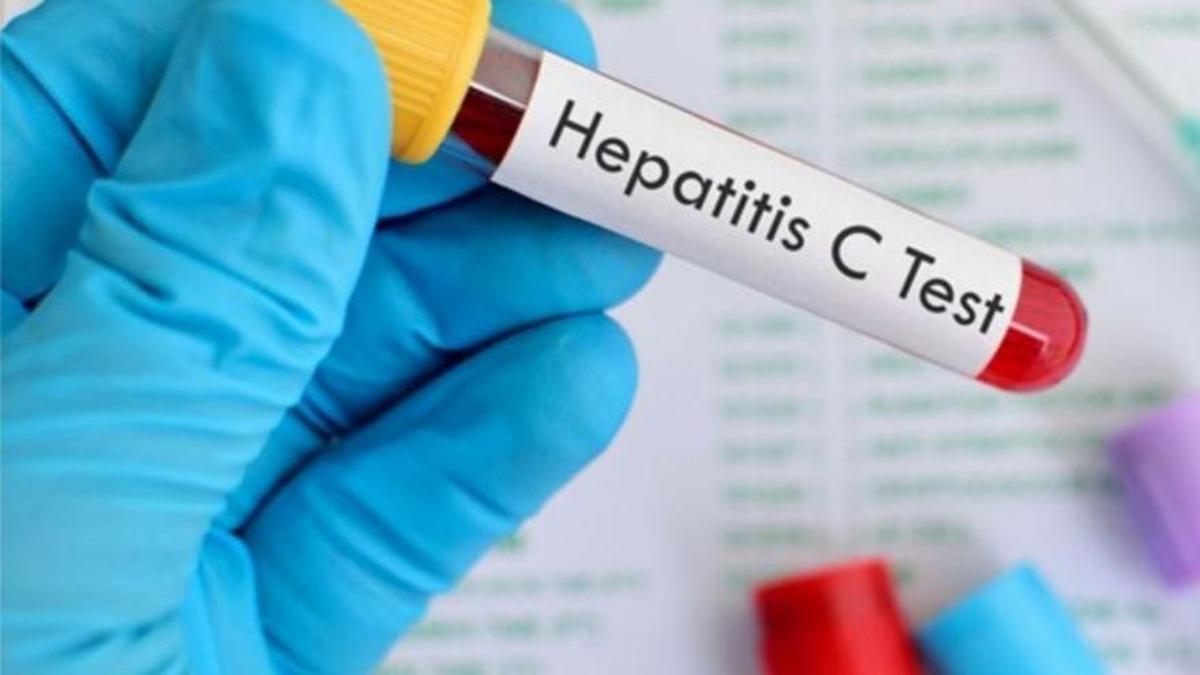 Un test d'hepatitis C. | SHUTTERSTOCK