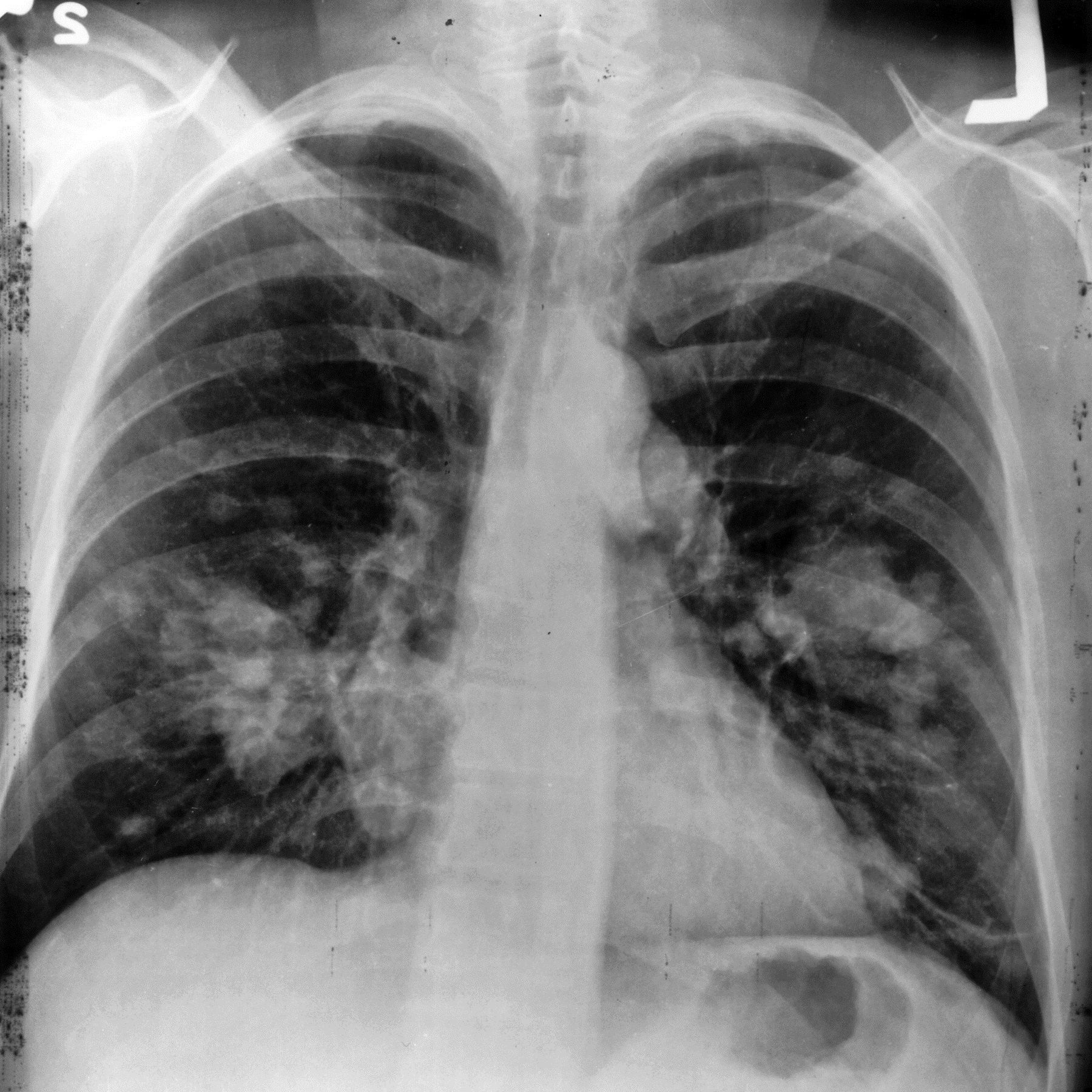 Cáncer de pulmón investigación