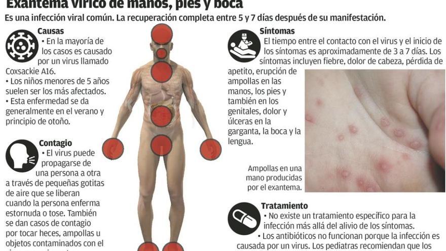 Un fuerte brote del virus "boca, mano, pie" dispara las citas de pediatría  - La Nueva España