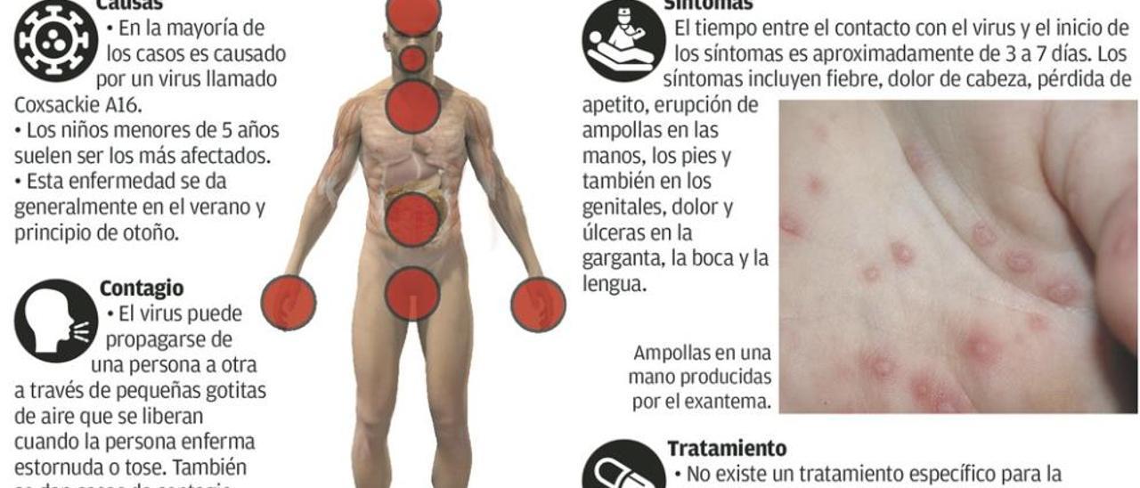 Un fuerte brote del virus &quot;boca, mano, pie&quot; dispara las citas de pediatría