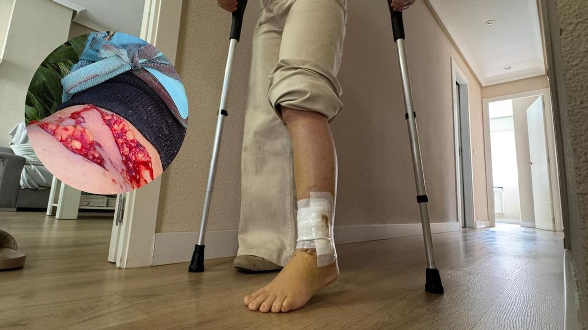 La vecina afectada en Elda con las lesiones que sufrió que le han dejado en muletas por el momento.