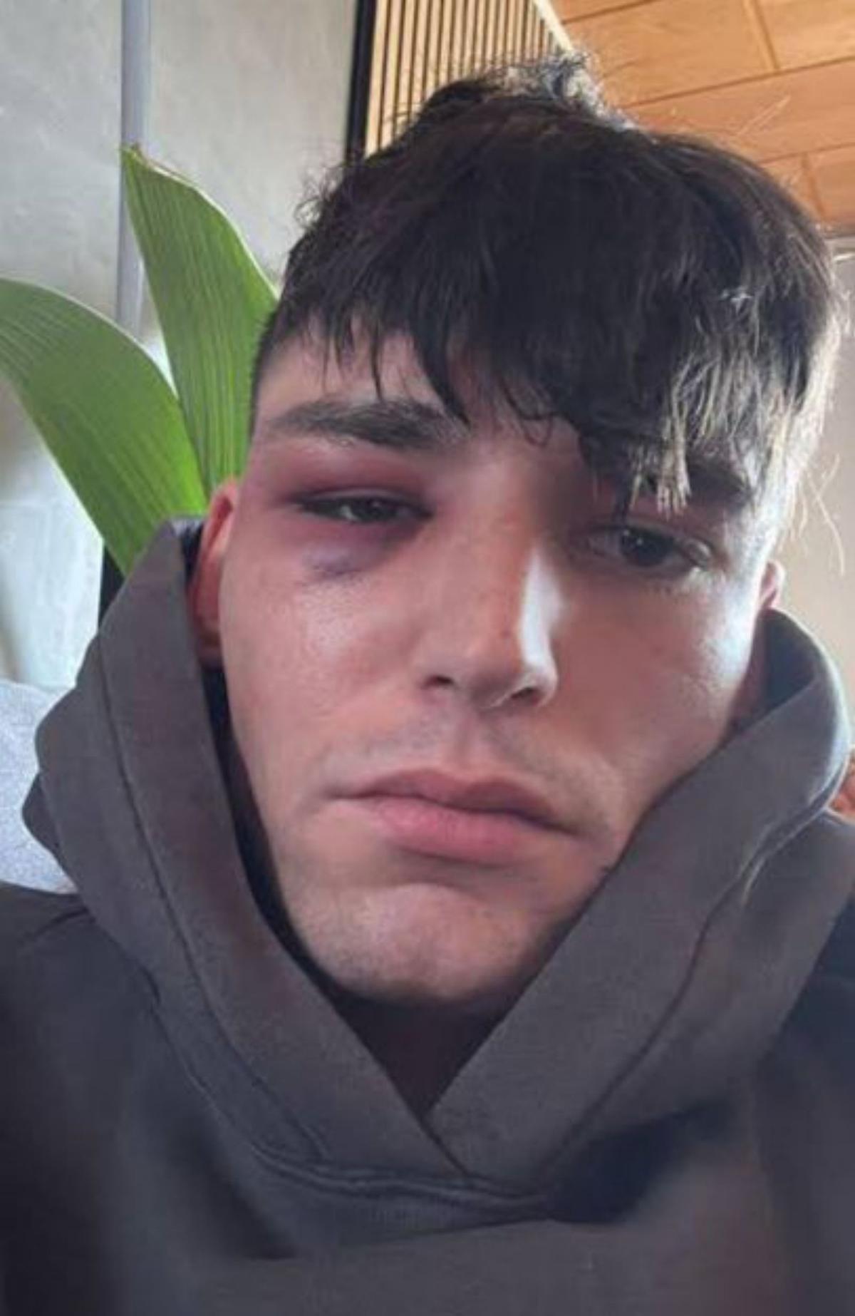 Pascal Kaiser després de l'agressió