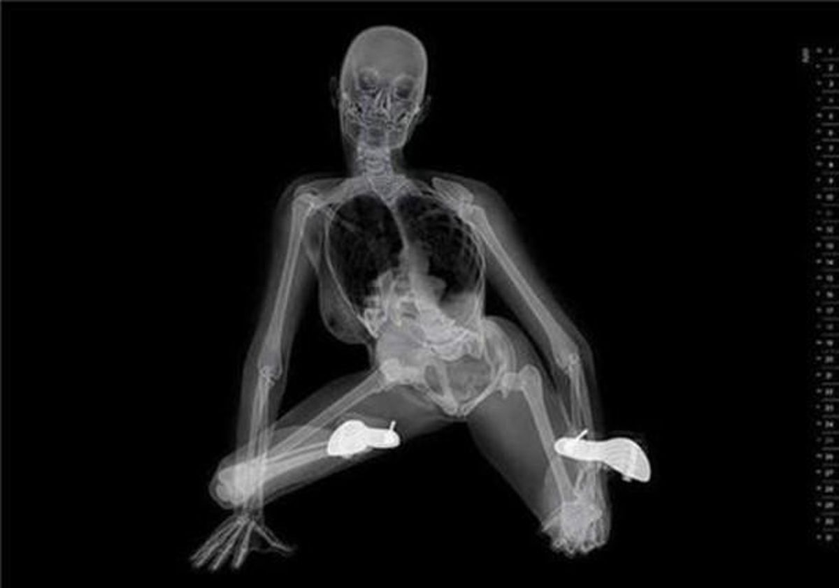 Una de les radiografies de la polèmica. Una de les radiografies de la polèmica.
