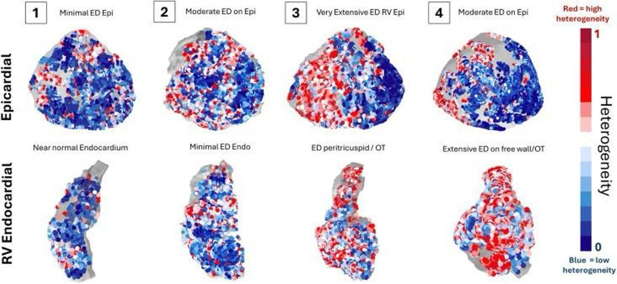 Métrica Vector Field Heterogeneity (VFH), indicador diseñado para cuantificar las heterogeneidades de propagación local en las señales eléctricas del corazón.