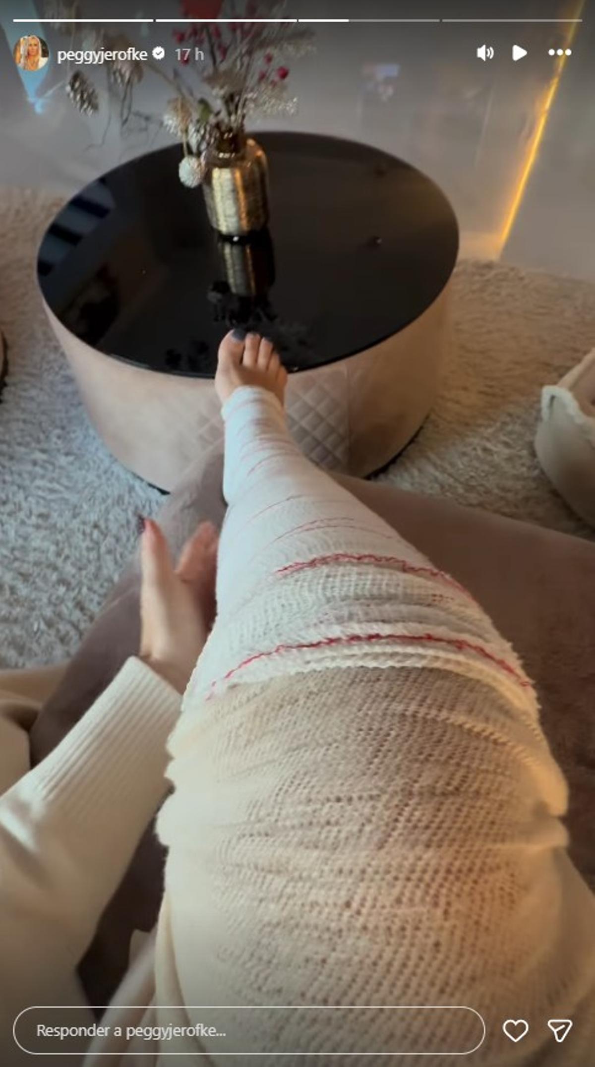 Für ihre Follower auf Instagram hat Jerofke ihren Verband abgenommen. Das Ergebnis gab es eine Story später.