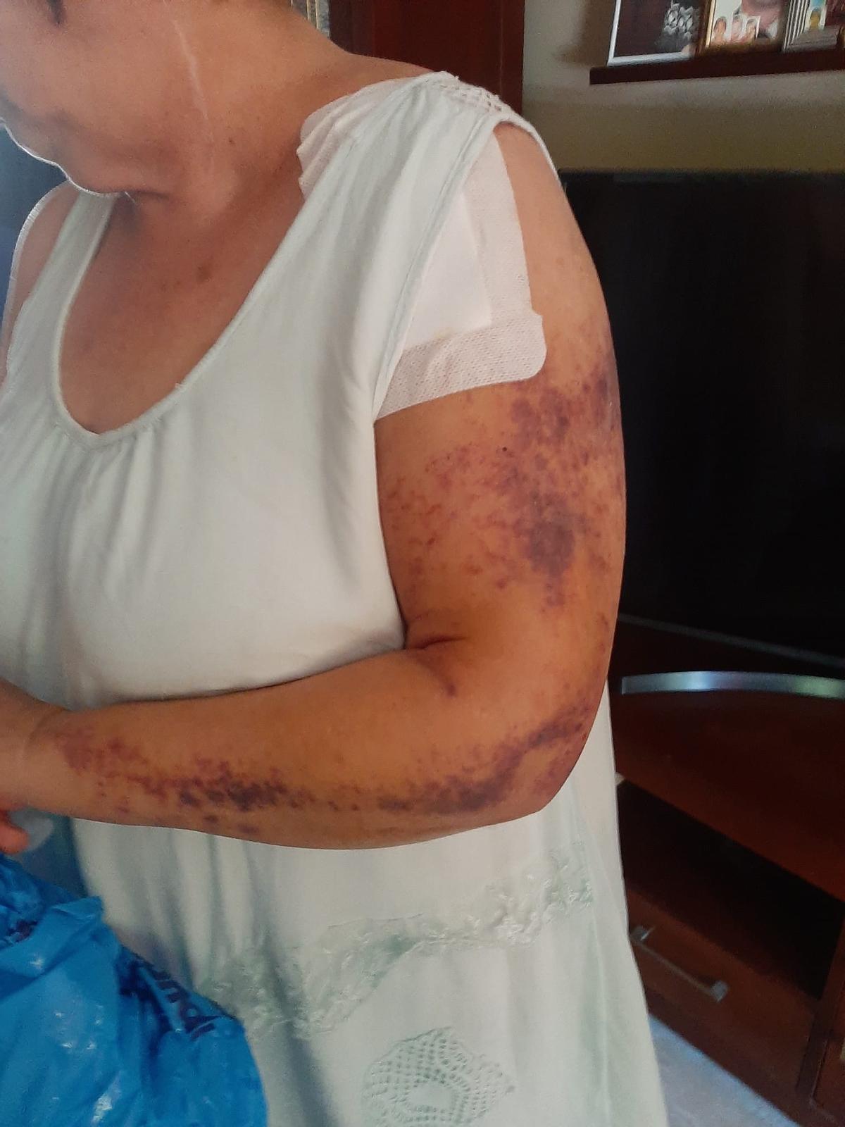 La mujer se rompió un hombro y tuvo que ponerse una prótesis por culpa del accidente.
