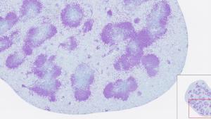 Las nanopartículas desarrolladas en Johns Hopkins lograron inducir la destrucción de la mayoría de las células del sistema inmunitario.