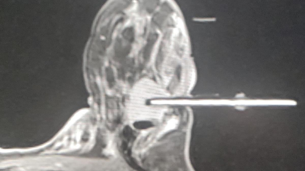 Biopsia con aguja de vacio guiada por resonancia magnetica.