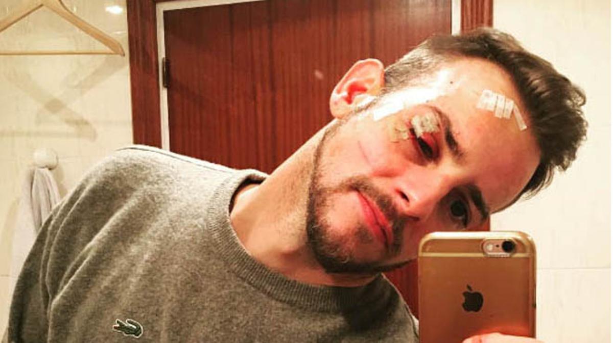 Álex Casademunt publica una foto de la seva agressió